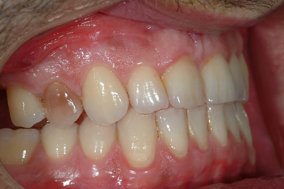 Prima del trattamento - Riabilitazione implanto-protesica su dente fratturato