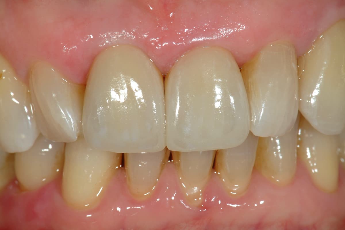 Restauri protesici sugli incisivi centrali