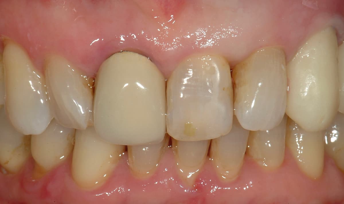 Prima del trattamento - Restauri protesici sugli incisivi centrali