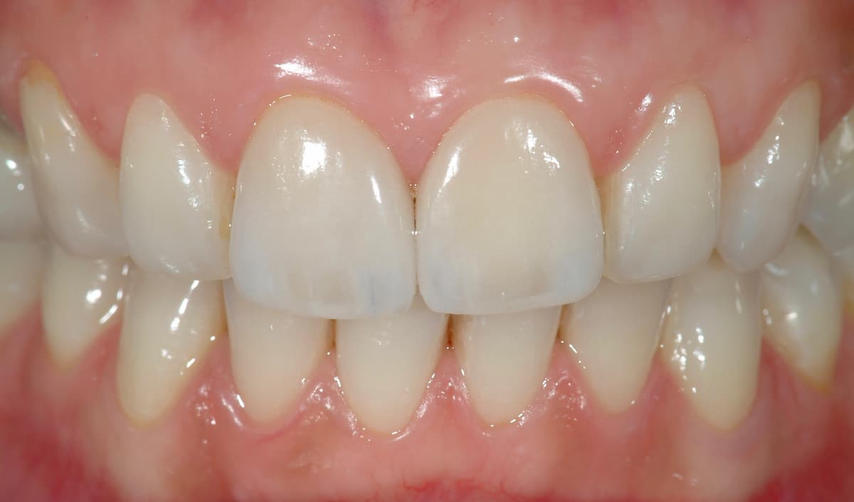 Restyling degli incisivi centrali