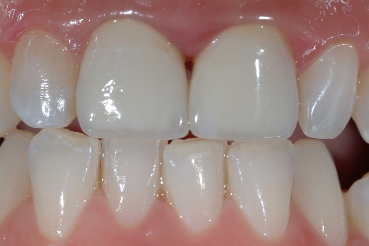 Prima del trattamento - Sostituzione di vecchi restauri incongrui