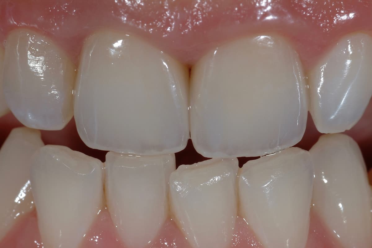 Sostituzione di vecchi restauri incongrui