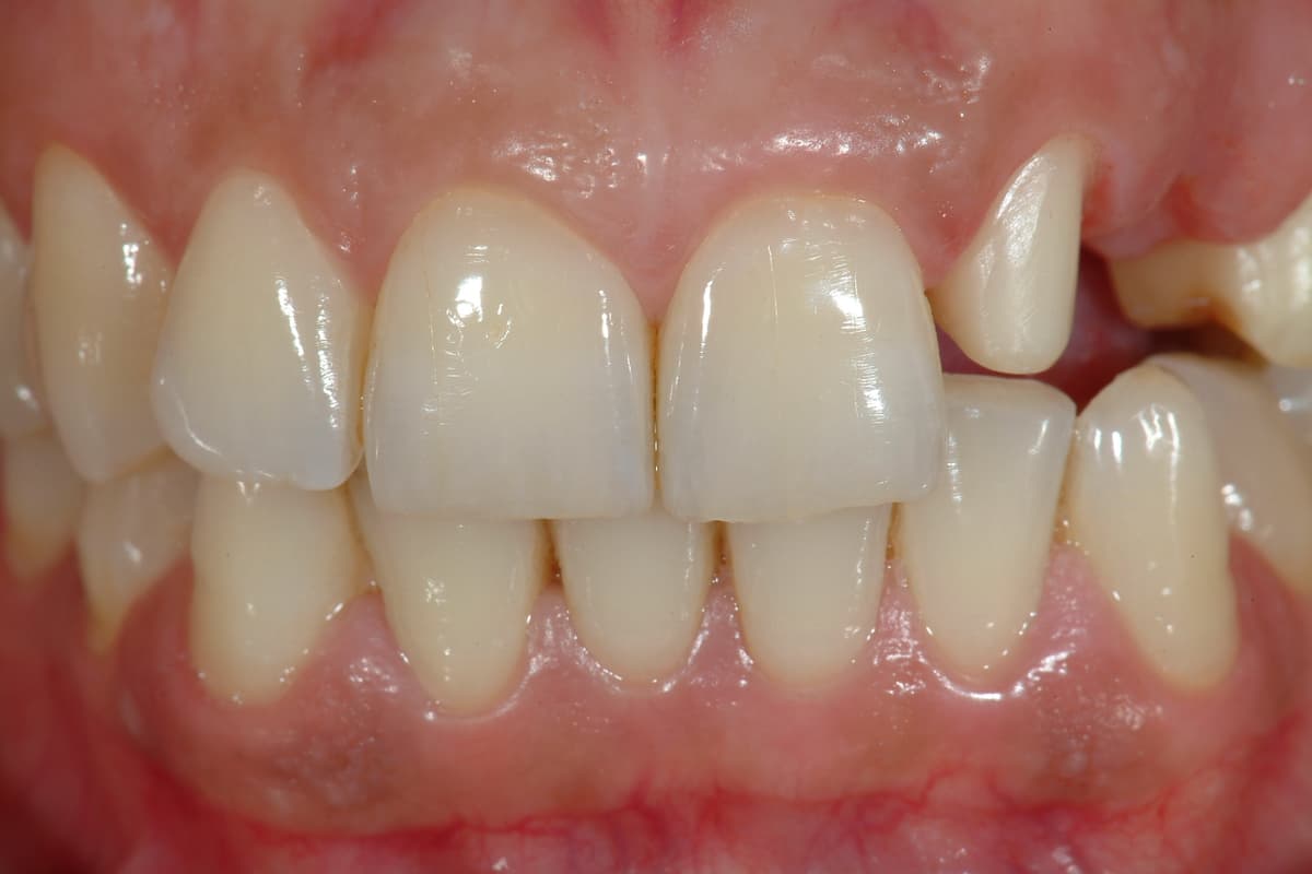 Prima del trattamento - Riabilitazione protesica