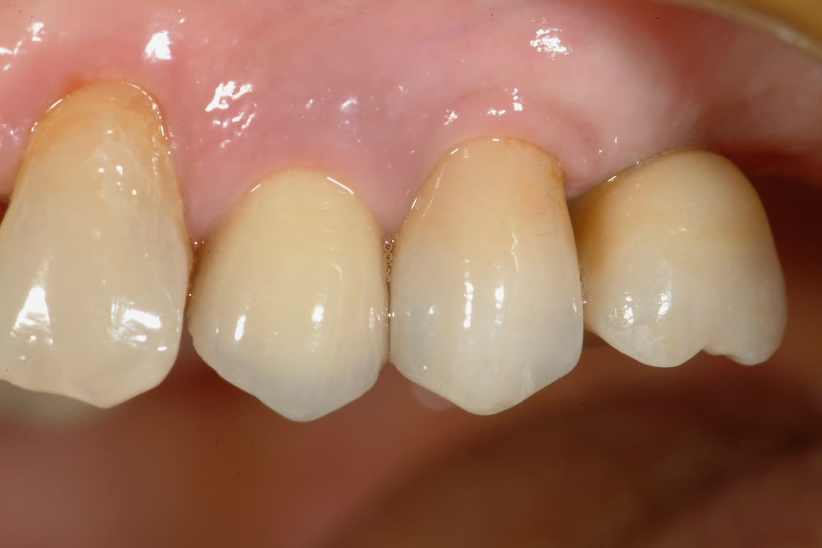 Riabilitazione implanto-protesica