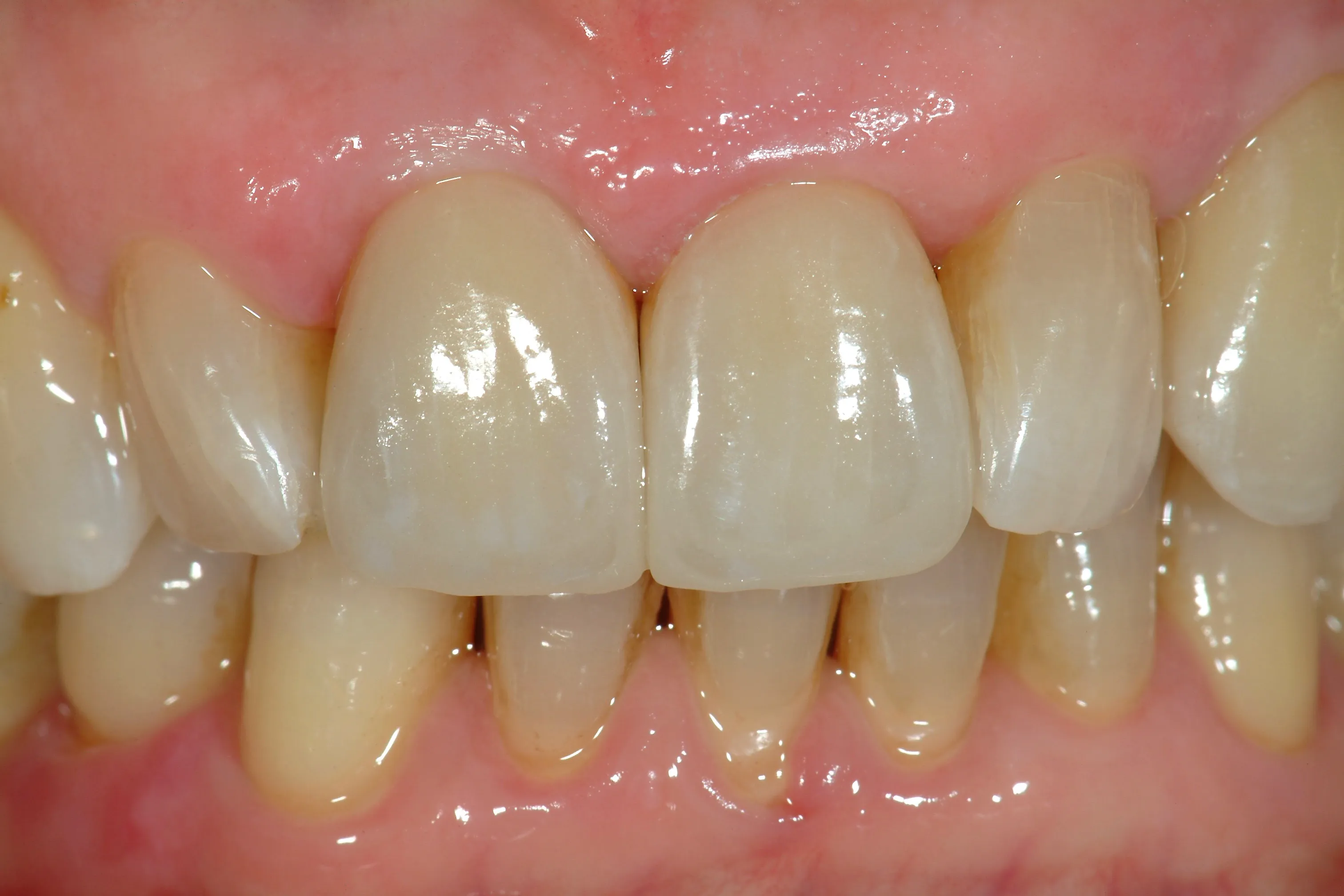 Restauri protesici sugli incisivi centrali